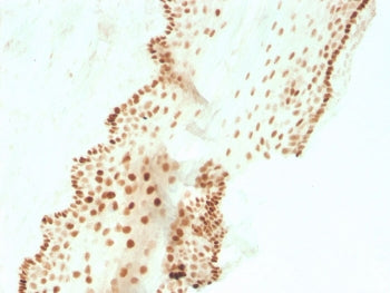IHC staining of FFPE human cervical carcinoma with recombinant SOX2 antibody (clone SOX2/3811R). HIE