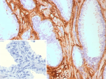 IHC staining of FFPE human prostate carcinoma tissue with recombinant DCN antibody (clone rDCN/9075)