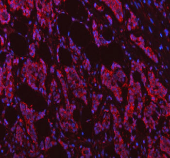 Immunofluorescent staining of FFPE human breast cancer tissue with NDUFB7 antibody (red) and DAPI nu