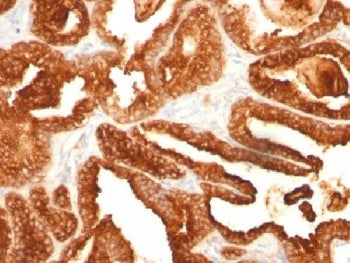IHC testing of human prostate carcinoma with PSAP antibody (clone SPM312). Required HIER: boil tissu