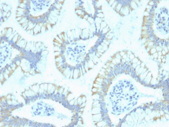 IHC staining of FFPE human colon carcinoma with SMAD4 antibody (clone SPM448). HIER: boil tissue sec