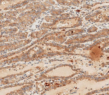 IHC staining of FFPE human thyroid carcinoma with WNT5A antibody. HIER: boil tissue sections in pH 9