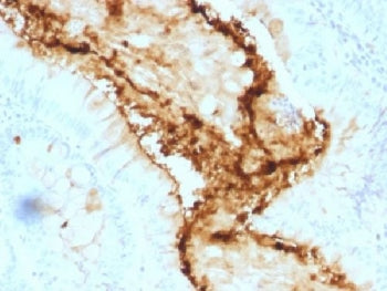 IHC testing of FFPE human colon carcinoma with Lewis y antibody (clone A70-A/A9). Required HIER: boi