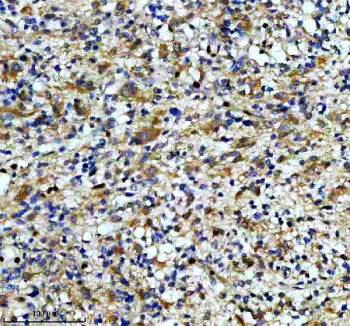 IHC staining of FFPE human glioma tissue with CAMK2 antibody, HRP-secondary and DAB substrate. HIER: