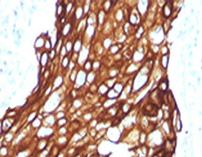 IHC testing of FFPE human lung carcinoma with recombinant Acidic Cytokeratin antibody (clone RMAK1-1