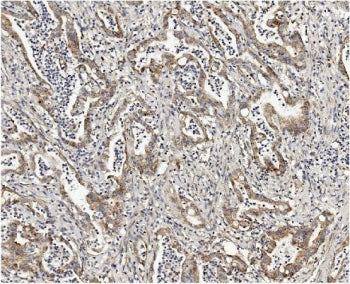 IHC staining of FFPE human rectal cancer with MMUT antibody. HIER: boil tissue sections in pH8 EDTA 