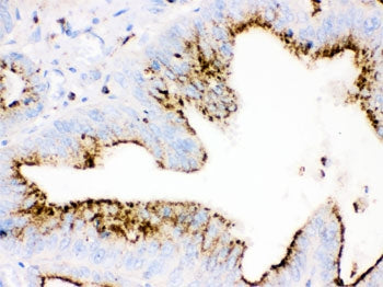 IHC testing of FFPE human intestinal cancer tissue with Cathepsin D antibody. HIER: steamed with pH6