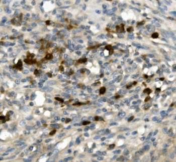 IHC staining of FFPE human rectal cancer with GFI1 antibody. HIER: boil tissue sections in pH8 EDTA 