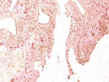 IHC: Formalin-fixed, paraffin-embedded human small cell lung carcinoma stained with Chromogranin A a