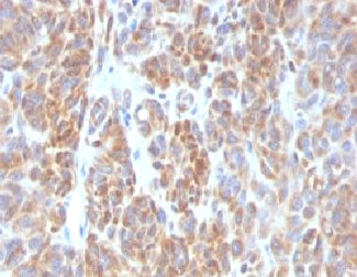 IHC testing of FFPE human melanoma with Bcl2 antibody (clone ARBC2-1). HIER: boil tissue sections in