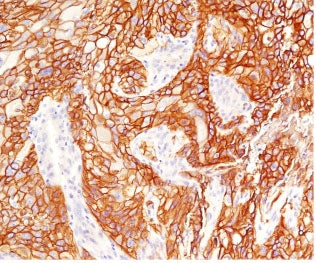 IHC testing of FFPE human lung squamous cell carcinoma with EGFR antibody (clone ERB68-1). Required 