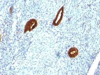 IHC analysis of formalin-fixed, paraffin-embedded human endometrial carcinoma stained with anti-CK19