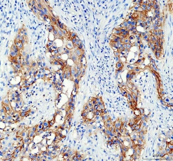 IHC staining of FFPE human bladder cancer tissue with AQP3 antibody. HIER: boil tissue sections in p