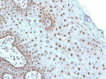 IHC: Formalin-fixed, paraffin-embedded human cervical carcinoma stained with c-Myc antibody (MYC275)