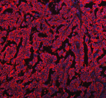 Immunofluorescent staining of FFPE human ovarian cancer tissue with EML4 antibody (red) and DAPI nuc