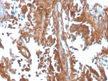 IHC testing of FFPE human urothelial carcinoma with SERBP1 antibody (clone SERBP1/3497). Required HI