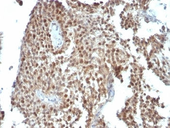 IHC: Formalin-fixed, paraffin-embedded human colon carcinoma stained with anti-p21 antibody (clone S