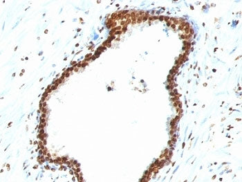 IHC staining of FFPE human colon carcinoma with dsDNA antibody (clone 121-3). HIER: boil tissue sect
