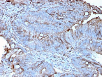 IHC staining of FFPE human colon carcinoma with MerTK antibody (clone MERTK/3022). HIER: boil tissue