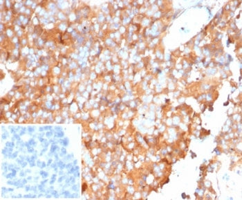 IHC staining of FFPE human ovarian carcinoma tissue with SERPINA1 antibody (clone AAT/6323). Inset: 