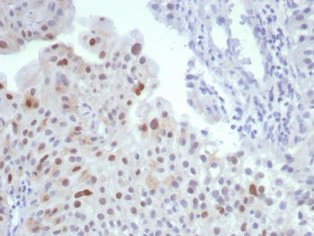 IHC staining of FFPE human bladder tissue with MDM2 antibody (clone MDM2/7190R). HIER: boil tissue s