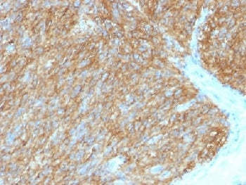 IHC testing of FFPE human gastrointestinal stromal tumor (GIST) with DOG1 antibody (clone DG1/1486).