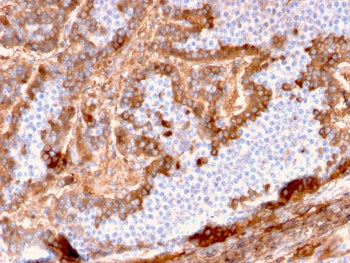 IHC testing of FFPE human hepatocellular carcinoma with Albumin antibody (clone ALB/2144). Required 