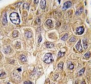 IHC testing of FFPE human hepatocellular carcinoma tissue with Squalene synthase antibody. HIER: ste