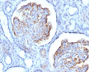 IHC testing of FFPE human mesothelioma with recombinant WT1 antibody (clone RMWT1-1). Required HIER: