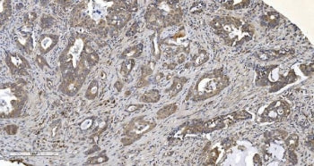 IHC staining of FFPE human gallbladder adenocarcinoma tissue with ARG2 antibody. HIER: boil tissue s
