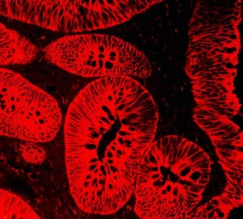 Immunofluorescent staining of FFPE human rectal cancer tissue with Cytokeratin 18 antibody. HIER: st