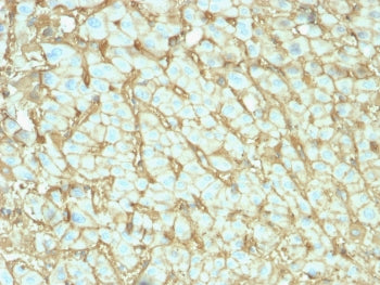 IHC testing of FFPE human hepatocellular carcinoma with human Albumin antibody (clone ALB/2142). Req