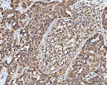 IHC staining of FFPE human parotid acinar cell carcinoma tissue with MECR antibody. HIER: boil tissu