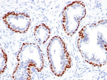 IHC testing of FFPE human prostate cancer with recombinant p63 antibody (clone TP63/1423R). Required
