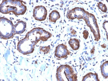 IHC testing of FFPE human breast carcinoma with recombinant Ferritin Light Chain antibody (clone FTL
