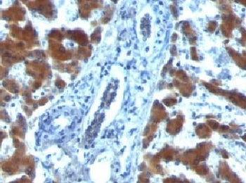IHC: Formalin-fixed, paraffin-embedded human hepatocellular carcinoma stained with RBP1 (clone RBP/8