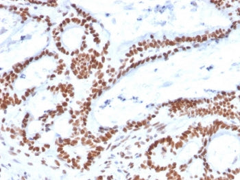 IHC staining of FFPE human colon carcinoma with MSH2 antibody. HIER: boil tissue sections in pH 9 10