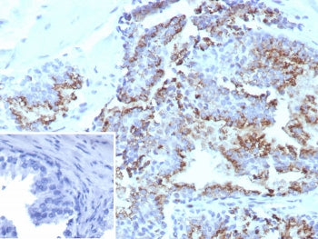 IHC staining of FFPE human prostate tissue with Prostein antibody (clone SLC45A3/7648). Inset: PBS u