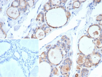 IHC staining of FFPE human thyroid carcinoma tissue with recombinant TPO antibody (clone rTPO/7248).