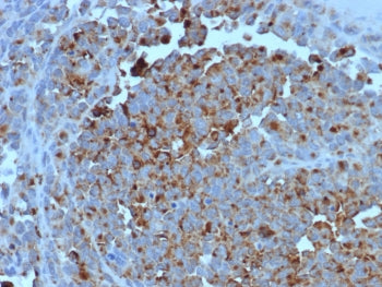 IHC staining of FFPE human melanoma tissue with CD63 antibody (clone LAMP3/7369). HIER: boil tissue 