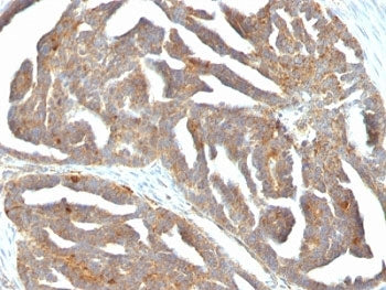 IHC: Formalin-fixed, paraffin-embedded human ovarian carcinoma stained with GnRH Receptor antibody (