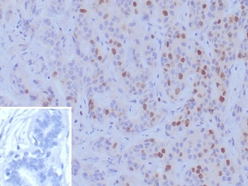 IHC staining of FFPE human breast carcinoma tissue with BRCA1 antibody (clone BRCA1/9797R). Inset: P
