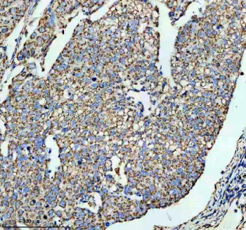 IHC staining of FFPE human cervical cancer tissue with SLC16A1 antibody, HRP-secondary and DAB subst