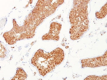 IHC staining of FFPE human testicular carcinoma with INHA antibody. HIER: boil tissue sections in pH