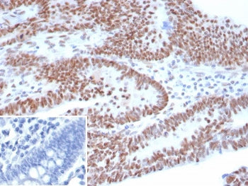 IHC staining of FFPE human ovarian carcinoma tissue with recombinant Tumor Protein 53 antibody (clon