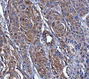 IHC staining of FFPE human breast cancer tissue with Dicer antibody. HIER: boil tissue sections in p