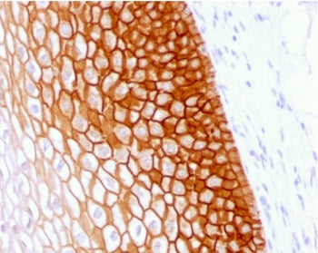 IHC testing of FFPE human cervical squamos cell carcinoma with recombinant CD44v4 antibody (clone CD