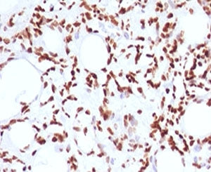 IHC testing of FFPE human angiosarcoma and Histone H1 antibody (clone OSHT-2). Staining of formalin/