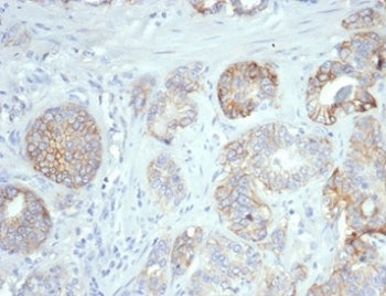 IHC staining of FFPE human ovarian carcinoma tissue with B7-H3 antibody (clone B7H3/4345). HIER: boi