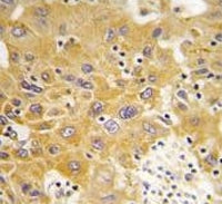IHC testing of FFPE human hepatocellular carcinoma tissue with CAMK1 delta antibody. HIER: steam sec